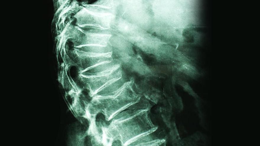 Radiografia-pueden-fracturas-vertebrales-Cedida_EDIIMA20190405_0715_19.jpg