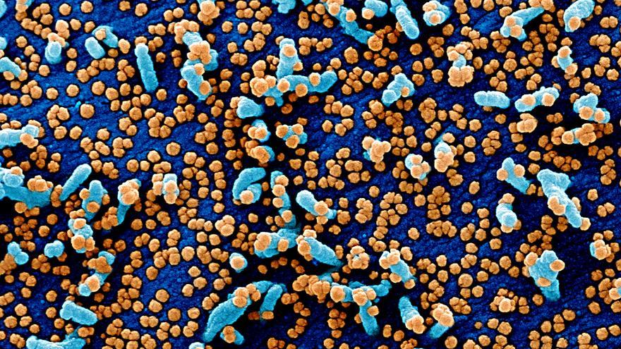  Micrografía electrónica de barrido coloreada de una célula VERO E6 (azul) muy infectada con partículas del virus SARS-COV-2 (naranja)