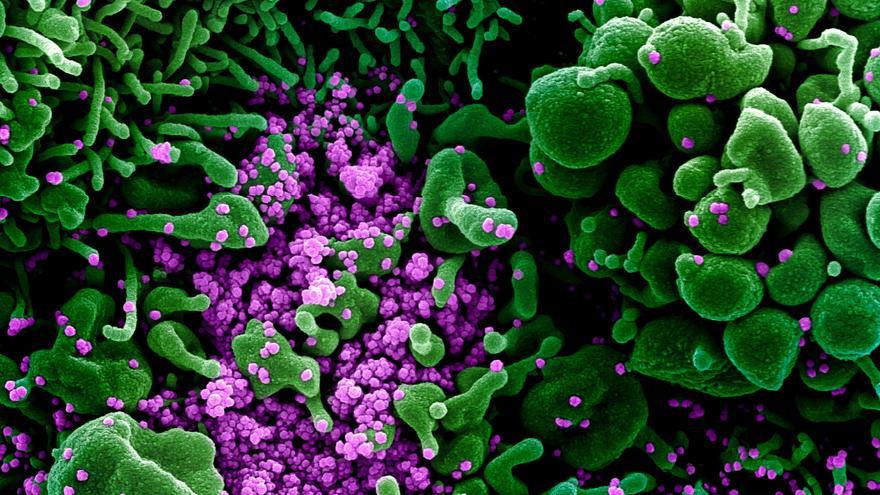  Micrografía electrónica de barrido coloreada de una célula apoptótica (verde) muy infectada con partículas del virus SARS-COV-2 (púrpura)